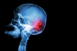 The 5 Most Common Types Of Traumatic Brain Injury