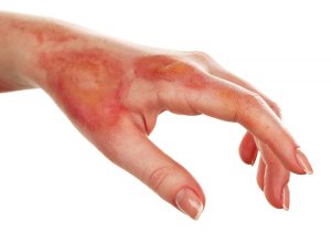 The Basics Of Burn Injuries