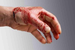 what-you-should-know-about-open-wounds