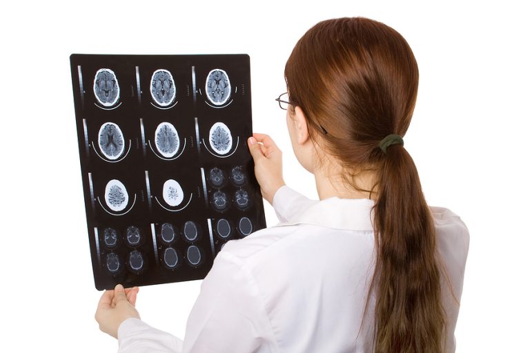 A Look at 4 Types of Traumatic Brain Injury and What This Means for Your St Petersburg Claim